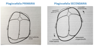 Plagiocefalia e osteopatia
